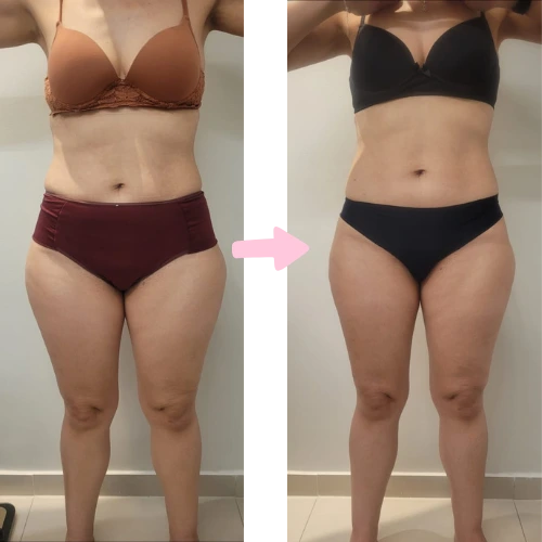 Resultado lipedema paciente 1