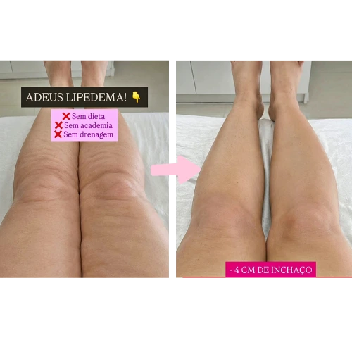 Resultado lipedema paciente 2