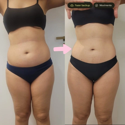 Resultado lipedema paciente 3