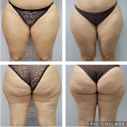 Resultado lipedema paciente 4