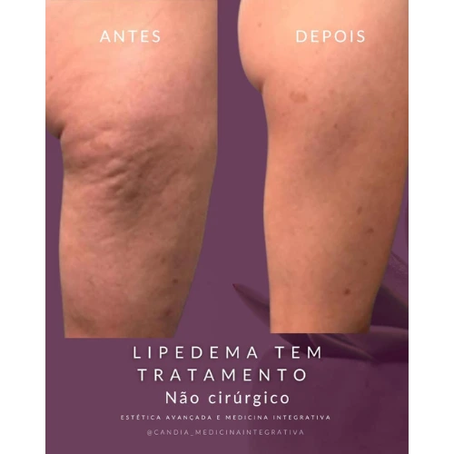 Resultado lipedema paciente 5