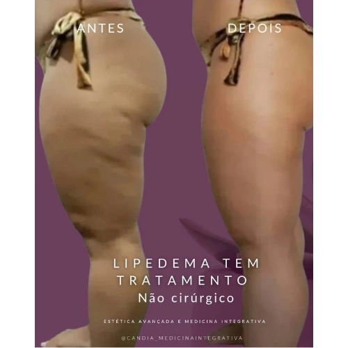 Resultado lipedema paciente 6
